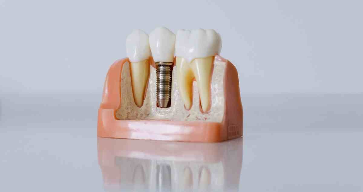 Dental Implants